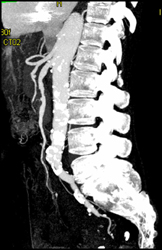 Diseased SMA With Ulcer - CTisus CT Scan