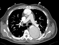 Dissection With Slow Flow in False Lumen - CTisus CT Scan