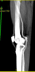 Popliteal Artery Aneurysm - CTisus CT Scan