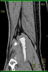 Popliteal Artery Aneurysm - CTisus CT Scan