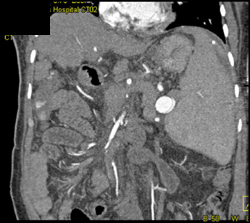 Splenic Artery Aneurysm - CTisus CT Scan