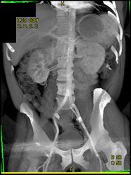 Aortic Plaque - CTisus CT Scan