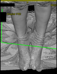 Stenosis at Iliac Bifurcation Lead to Great Toe Ulcers - CTisus CT Scan