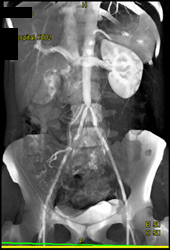 Stenosis of Distal Aorta Well Defined - CTisus CT Scan