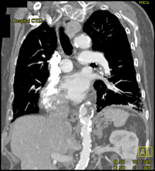 Plaque and Thrombus in Thoracic Aorta - CTisus CT Scan