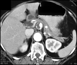 Celiac Artery Aneurysm - CTisus CT Scan