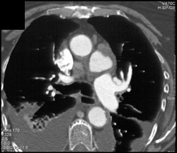 Ductus Aneurysm - CTisus CT Scan