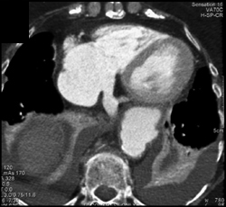 Aortic Aneurysm - CTisus CT Scan