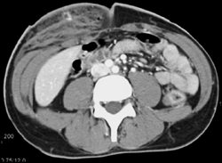 Bleed in Right Abdominal Wall - CTisus CT Scan