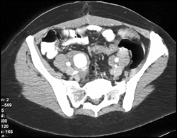 Right Common Iliac Artery Aneurysm - CTisus CT Scan