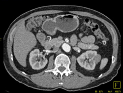 Dissection of the SMA - CTisus CT Scan