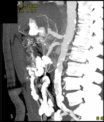 SMA and Celiac Artery Stenosis - CTisus CT Scan