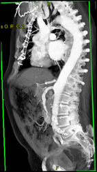 Celiac Artery Stenosis - CTisus CT Scan