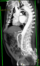 High Grade Celiac Artery Stenosis - CTisus CT Scan