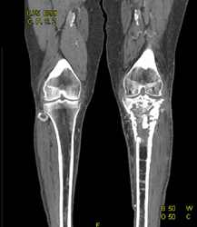 Diseased Trifurcation Bilaterally - CTisus CT Scan