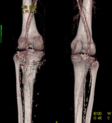 Diseased Trifurcation Vessels - CTisus CT Scan