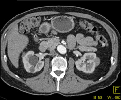 SMA Dissection in Patient With Back Pain - CTisus CT Scan