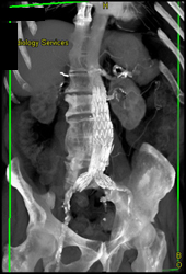 Stent Graft in Good Position - CTisus CT Scan