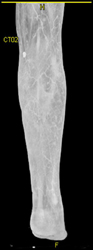 Run-off Study in Opaque and Transparent Volume Rendering - CTisus CT Scan