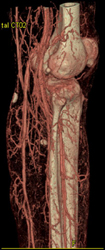 Patent Popliteal Arteries - CTisus CT Scan