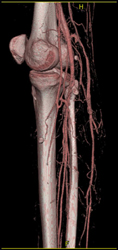 Ct Angiogram for Degloving Injury - CTisus CT Scan