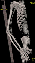 Angiogram of the Arm - CTisus CT Scan