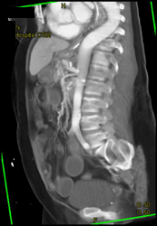 Celiac Artery Aneurysm - CTisus CT Scan