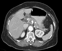 Celiac Artery Aneurysm That Is Partially Clotted - CTisus CT Scan