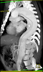 Type B Dissection - CTisus CT Scan