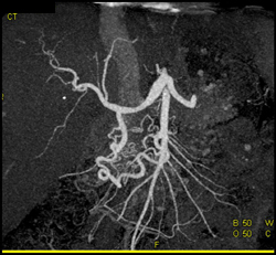 Median Arcuate Ligament Syndrome - CTisus CT Scan