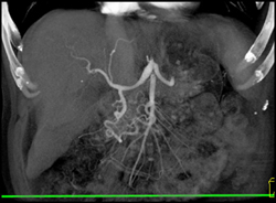 Median Arcuate Ligament Syndrome With Dilated Hepatic Artery - CTisus CT Scan