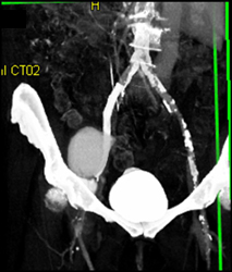 Pseudoaneurysm - CTisus CT Scan