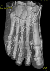 Ct Angiogram of the Feet - CTisus CT Scan