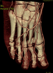 Ct Angiography of the Foot - CTisus CT Scan