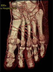 The Toes in 3D - CTisus CT Scan