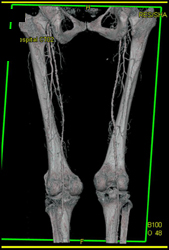 Diseased Superficial Femoral Artery Bilaterally - CTisus CT Scan