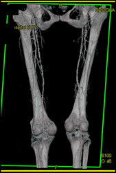 Diseased Superficial Femoral Artery (SFA) - CTisus CT Scan