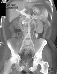 Aneurysm of the Gastroduodenal Artery (GDA) - CTisus CT Scan