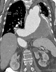 Large Aneurysm That Was Enlarging - CTisus CT Scan