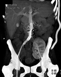 Occluded Left Common Iliac Artery. Renal Transplant Off External Iliac Artery - CTisus CT Scan