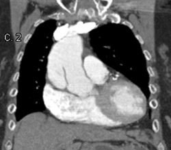 Type A Dissection - CTisus CT Scan