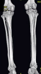 Normal Runoff Study - CTisus CT Scan