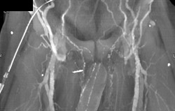 Prominent Collaterals - CTisus CT Scan