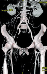 Occluded Right External Iliac Artery - CTisus CT Scan