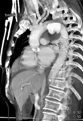 Ductus Aneurysm - CTisus CT Scan