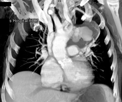 Ductus Aneurysm - CTisus CT Scan