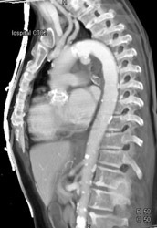 Ductus Aneurysm - CTisus CT Scan