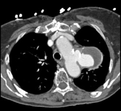 Ductus Aneurysm - CTisus CT Scan