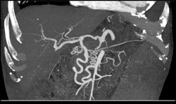 Prominent Gastroduodenal Artery (GDA) Due to Celiac Stenosis - CTisus CT Scan