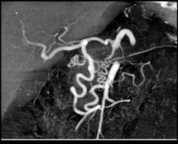 Median Arcuate Ligament Syndrome - CTisus CT Scan